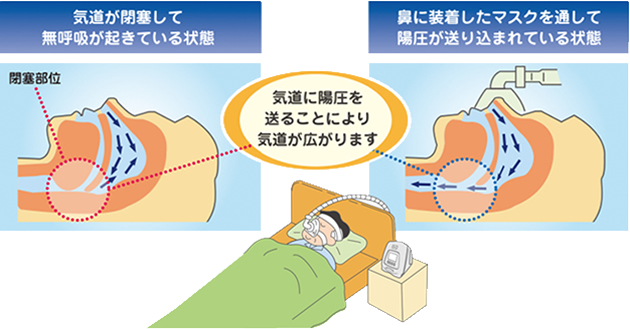 CPAP療法